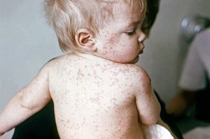Measles_childwithmeasles Think Measles Times Publishing Group Inc tpgonlinedaily.com